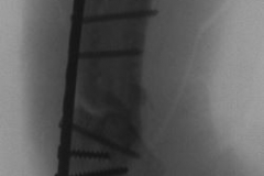 Idlib_Humerus_Break_August_17-29